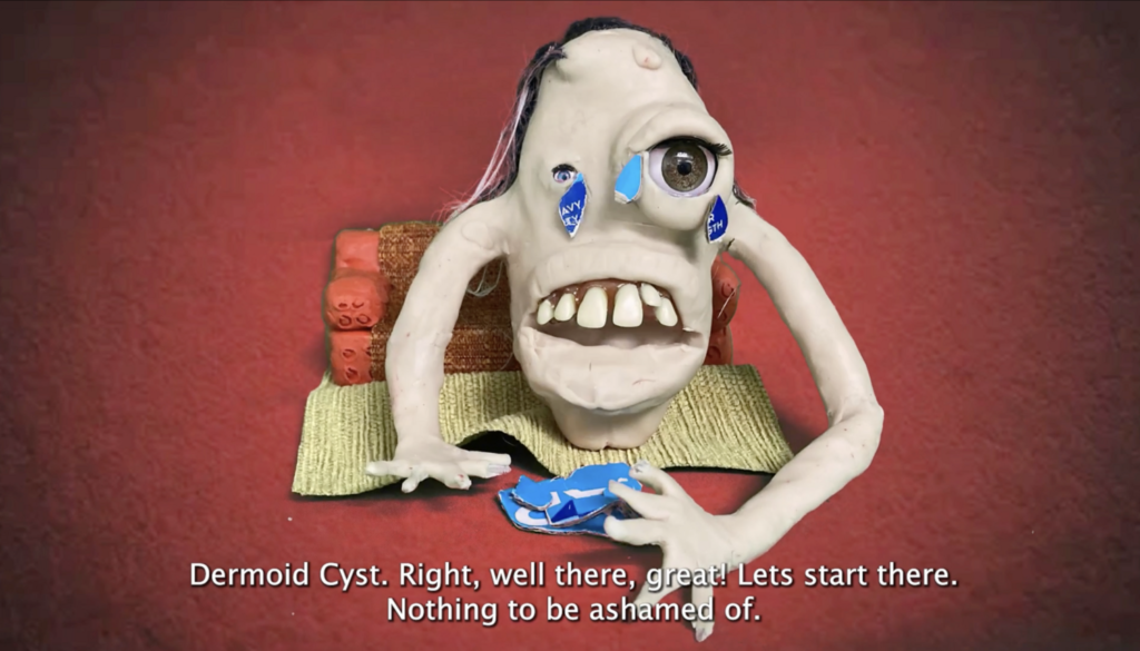 The Cyst and the Baby